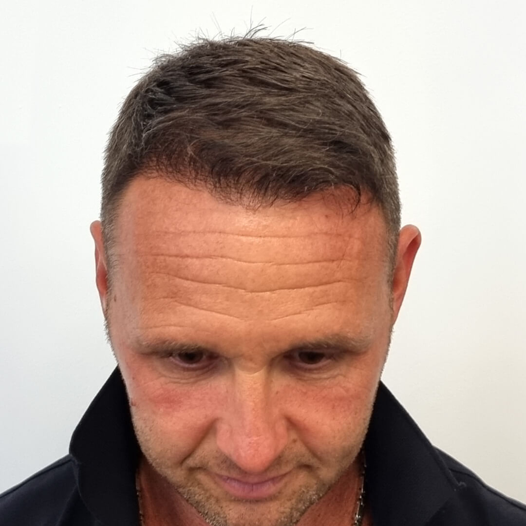 Hajbeültetés előtte-utána: József - HIMG hajbeültetési klinika