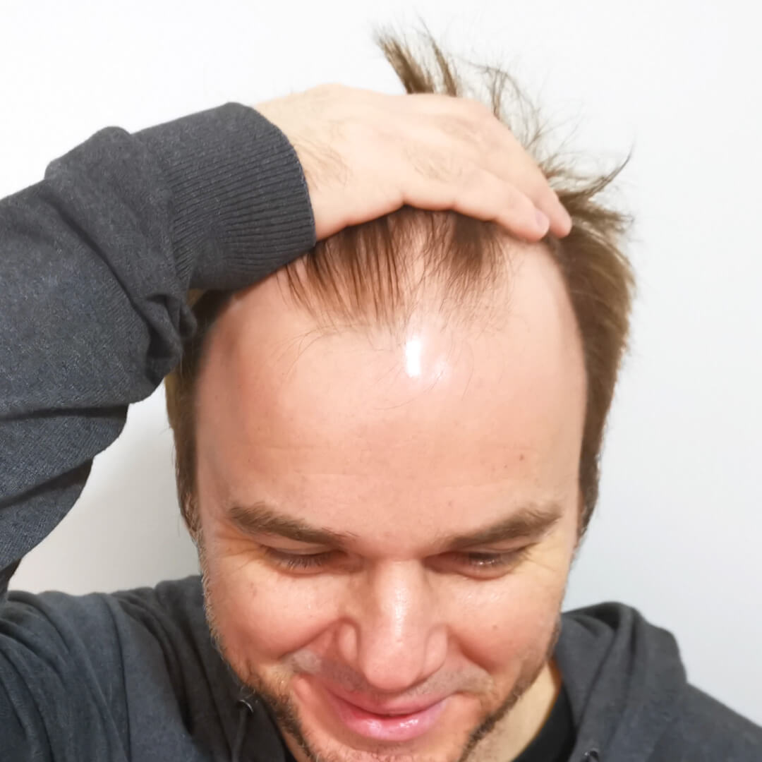 Hajbeültetés előtte-utána: Juhász Gergely (Rádió 1 műsorvezető, író) - HIMG hajbeültetési klinika