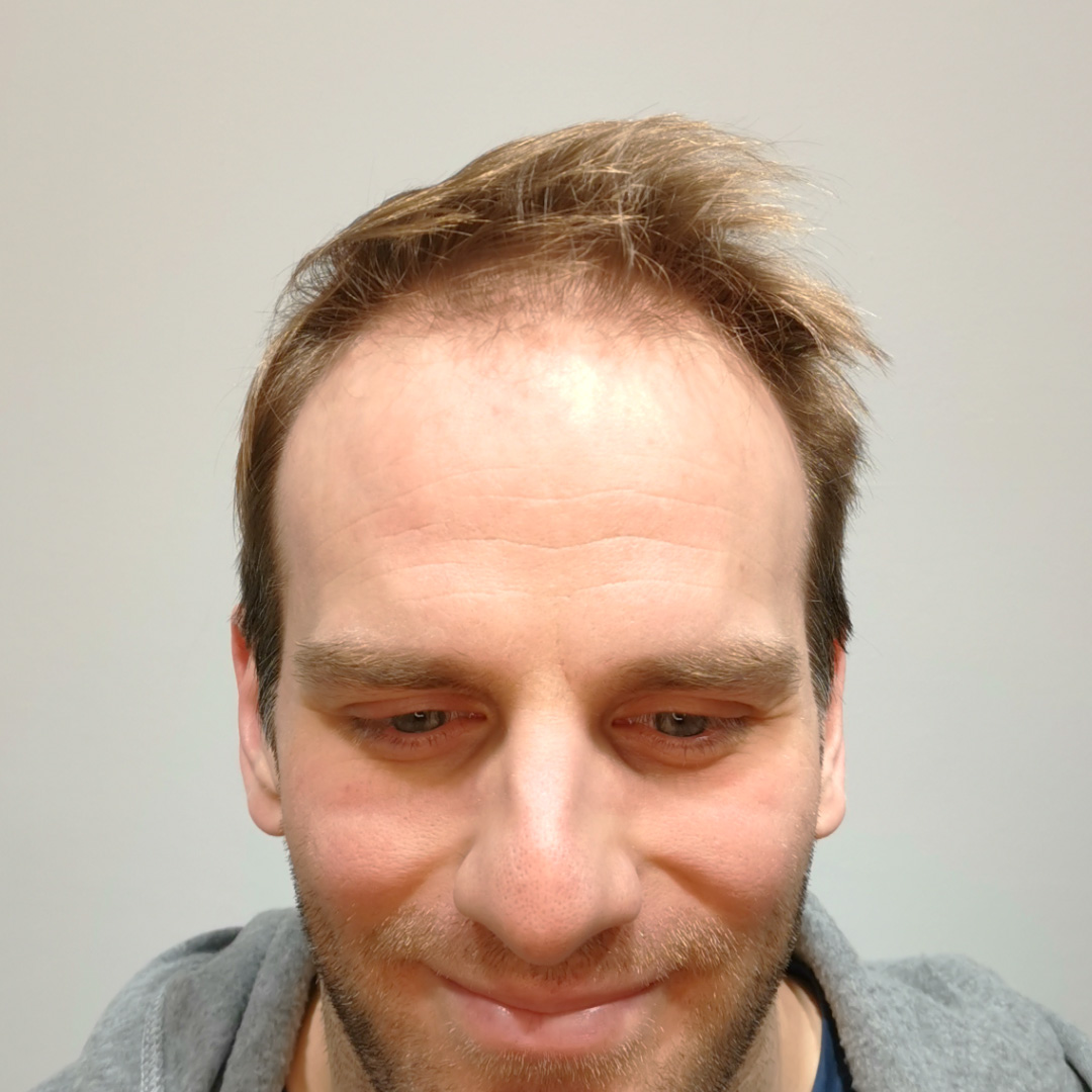 Hajbeültetés előtte-utána: Kókai Lénárd - HIMG Hajbeültetési Klinika