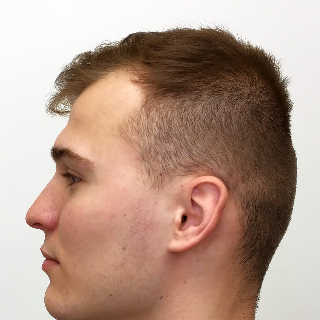 Hajbeültetés előtte-utána: Norbert - HIMG hajbeültetési klinika