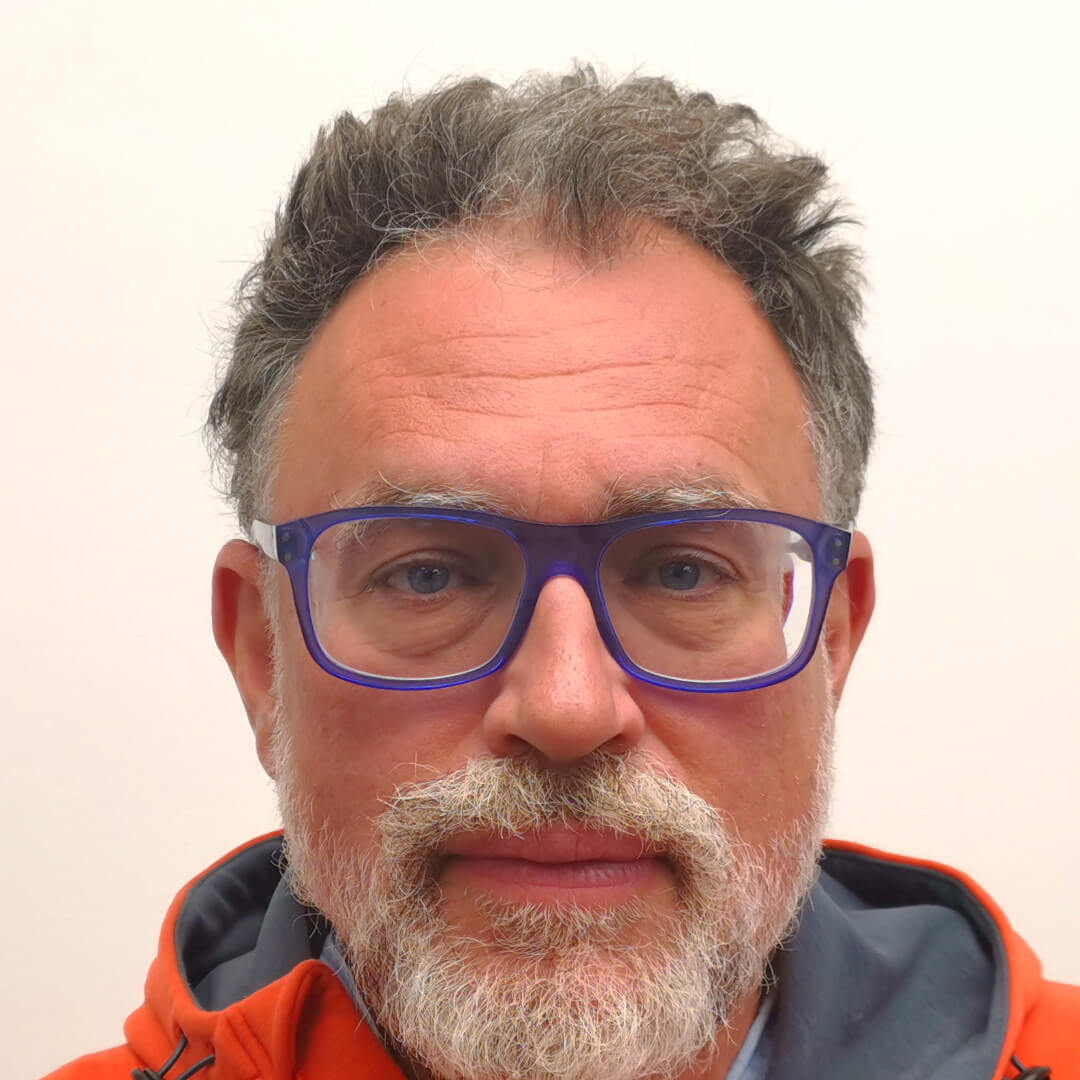 Hajbeültetés előtte-utána: Villám Géza - HIMG hajbeültetési klinika