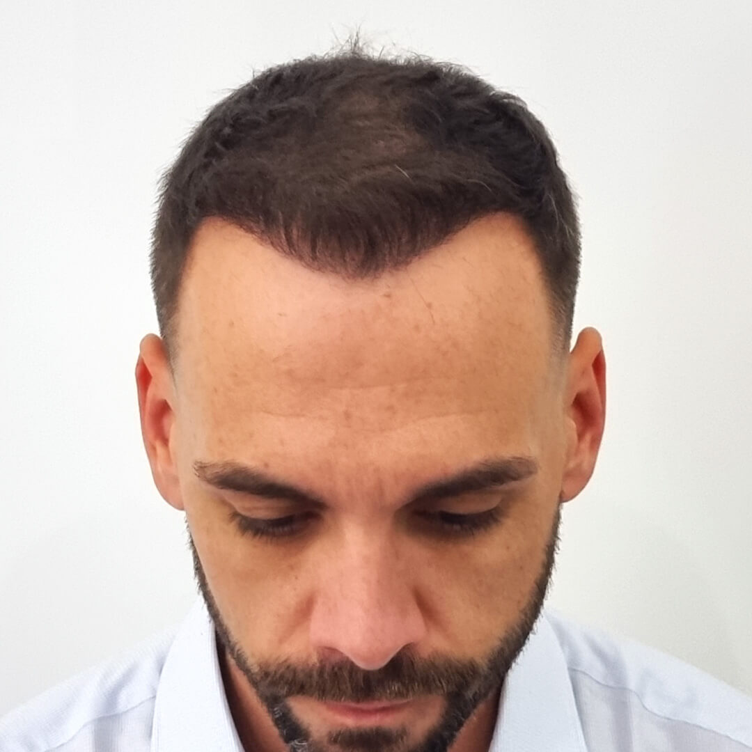 Hajbeültetés előtte-utána: Gergő - HIMG hajbeültetési klinika